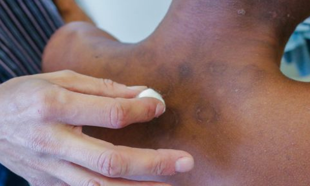 hanseniase:-pacientes-contam-historias-de-preconceito-e-superacao