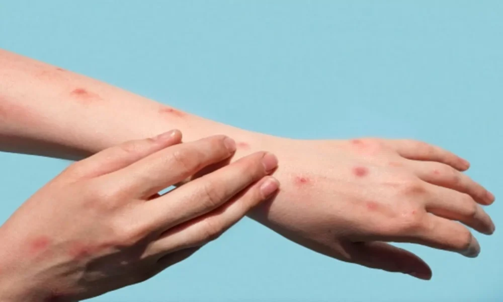 mpox:-eua-identificam-primeiro-caso-de-nova-cepa-em-viajante