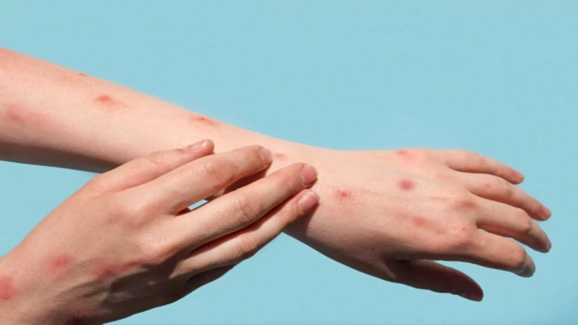 mpox:-eua-identificam-primeiro-caso-de-nova-cepa-em-viajante