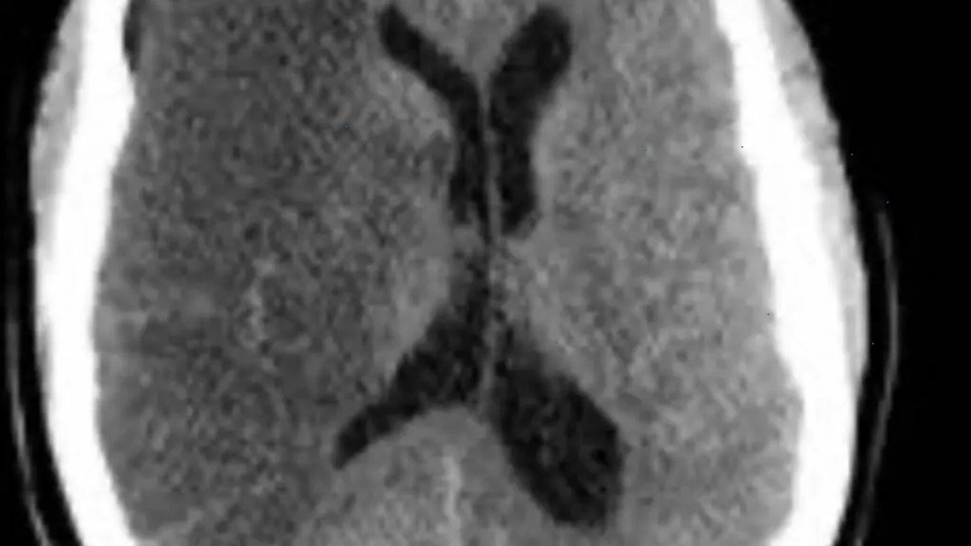 caso-raro:-professora-de-educacao-fisica-sofre-avc-durante-aula-em-academia