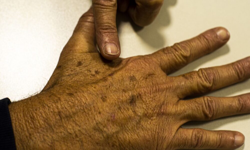 desinformacao-sobre-cancer-de-pele-afeta-diagnostico,-diz-instituicao