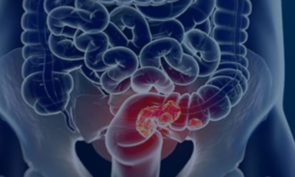 sus-adota-novo-exame-para-rastrear-cancer-colorretal-na-populacao
